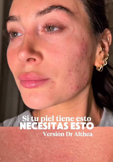✨ ¿Marcas de acné, rojeces y piel sensible?